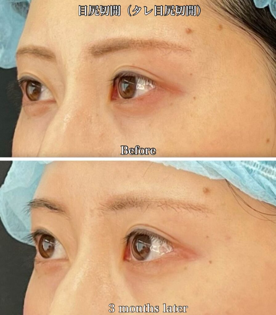 目尻切開