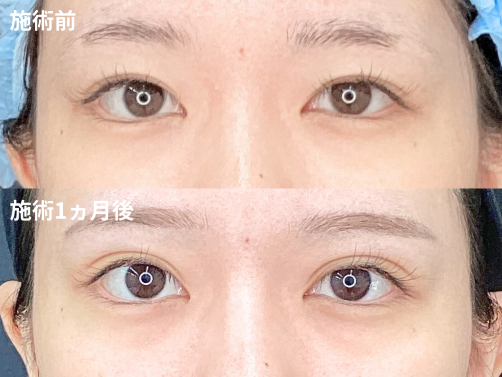 埋没法韓国式6点留め