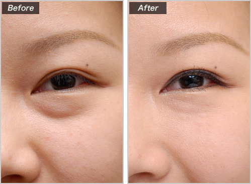 ヒアルロン酸注入