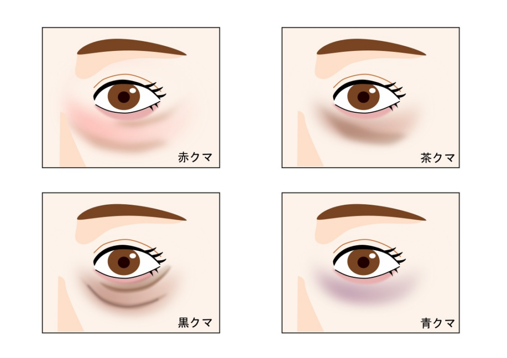 【目の下のクマ4種類】特徴と見分け方