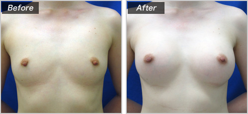 人工乳腺法（シリコンバッグ）による症例写真①　正面