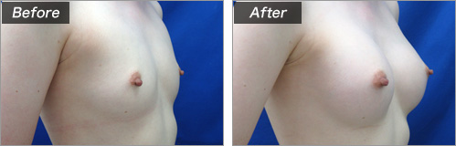 人工乳腺法（シリコンバッグ）による症例写真①　横
