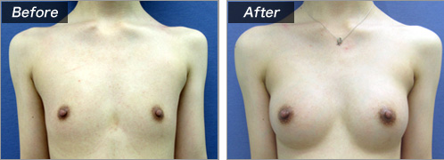 人工乳腺法（シリコンバッグ）による症例写真②　正面