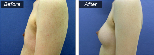 人工乳腺法（シリコンバッグ）による症例写真②　横
