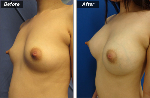 人工乳腺法（シリコンバッグ）による症例写真②　横