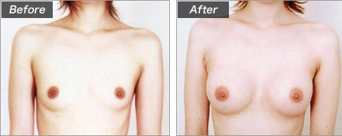 人工乳腺法（シリコンバッグ）による症例写真④　正面