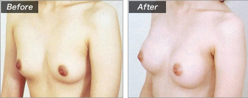 人工乳腺法（シリコンバッグ）による症例写真④　横
