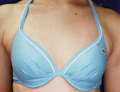 脂肪注入法による症例写真　before正面