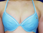 脂肪注入法による症例写真　after正面