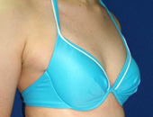 脂肪注入法による症例写真　before右横