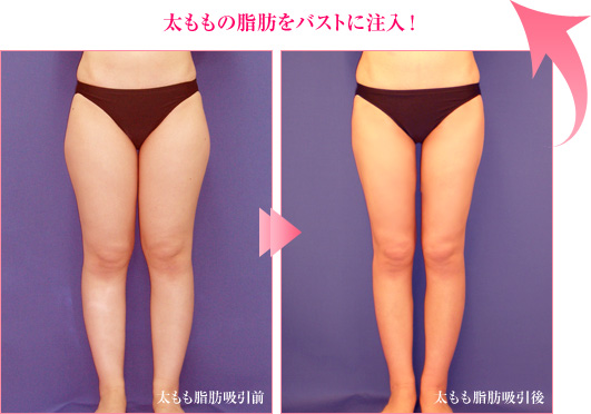 脂肪注入法による症例写真　太もも