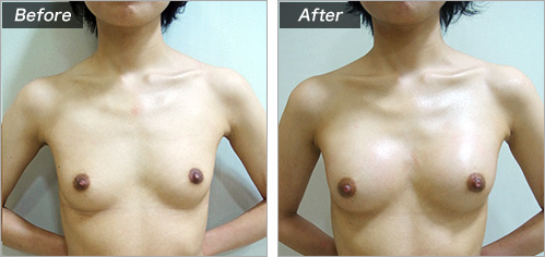 簡単・安全・長持ちする美しい自然なバストに　症例写真