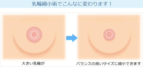 乳輪縮小術　before　afterイラスト