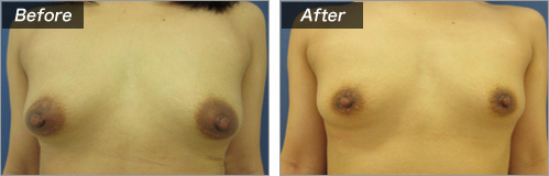 乳輪縮小術　症例写真①正面