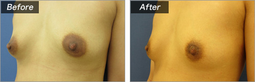 乳輪縮小術　症例写真①横