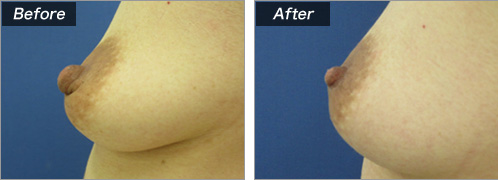乳輪縮小術　症例写真②
