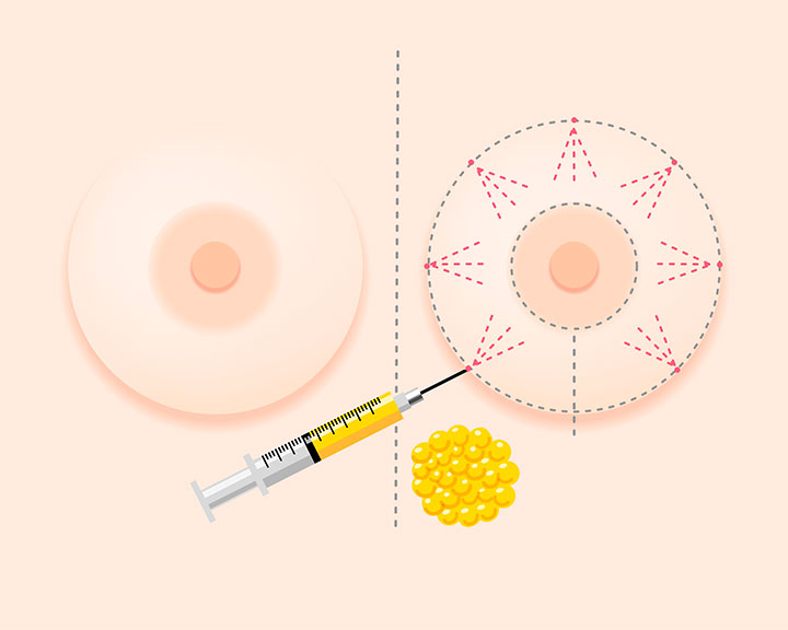 脂肪注入による豊胸術とは