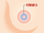 乳頭の近接部分（内側）を切除する方法
