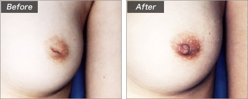 陥没乳頭形成術　before　after