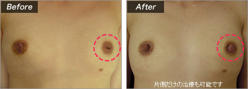 陥没の程度について　症例写真①