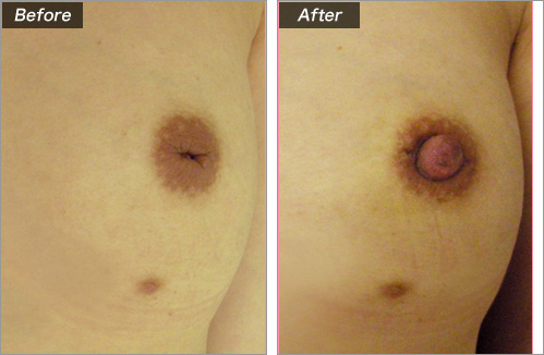 陥没の程度について　症例写真②
