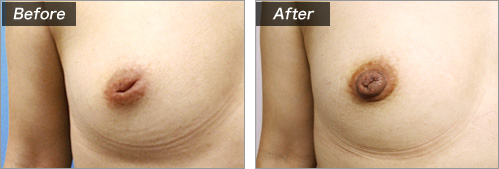 陥没の程度について　症例写真③