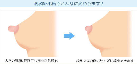 乳頭縮小術　イラスト解説