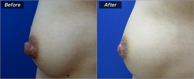 乳頭縮小術（術前・術後）①