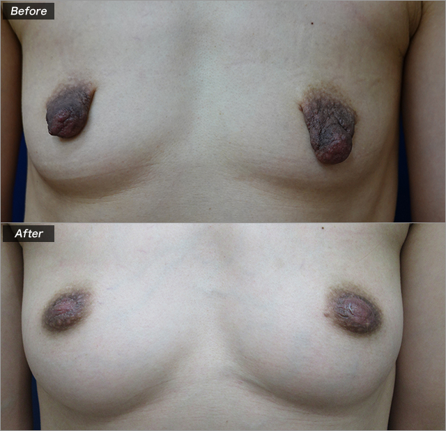 乳頭縮小術（術前・術後）②