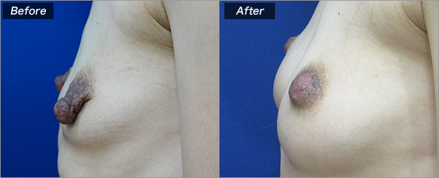 乳頭縮小術（術前・術後）③