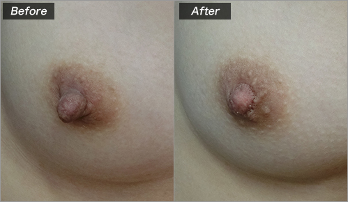 乳頭縮小術（術前・術後）⑥