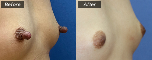 乳頭縮小術（術前・術後）⑦