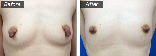 乳頭縮小術（術前・術後）⑧
