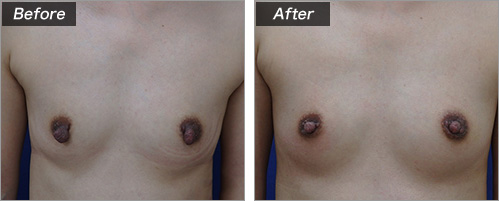 乳頭縮小術（術前・術後）⑨
