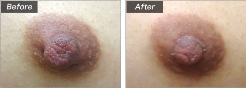 乳頭縮小術（術前・術後）⑩