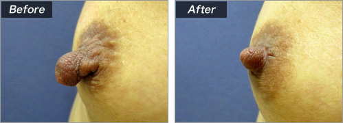 乳頭縮小術（術前・術後）⑪