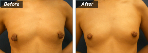 乳頭縮小術（術前・術後）⑫