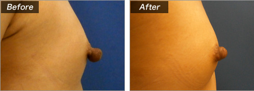 乳頭縮小術（術前・術後）⑬