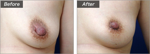 乳頭縮小術（術前・術後）⑭