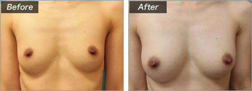 ピュアグラフト豊胸手術　正面（術前・術後）①