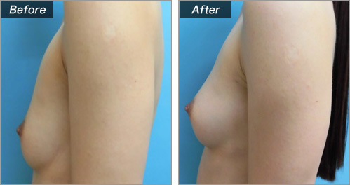 ピュアグラフト豊胸手術　横（術前・術後）①