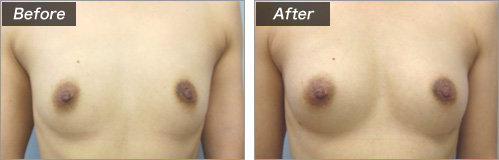 ピュアグラフト豊胸手術　正面（術前・術後）②