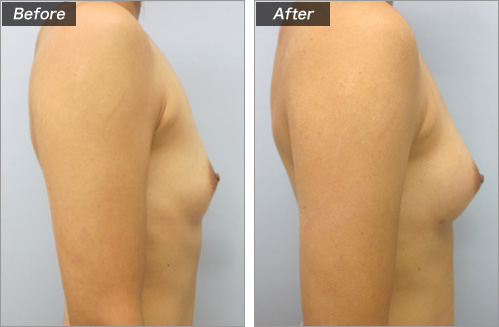 ピュアグラフト豊胸手術　横（術前・術後）②