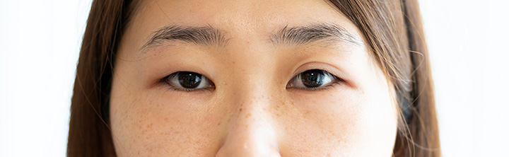 眼瞼下垂手術後の不具合イコール後遺症ではない