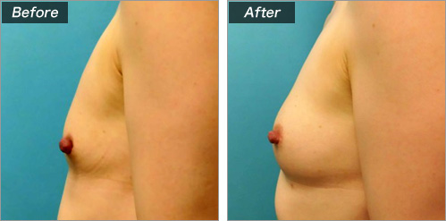 その他の症例写真　横（術前・術後）