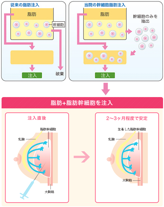 脂肪幹細胞注入法の特徴