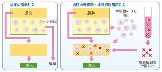 同時にPRPを注入することのメリット
