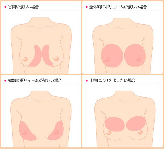 スベニール豊胸 イラスト解説