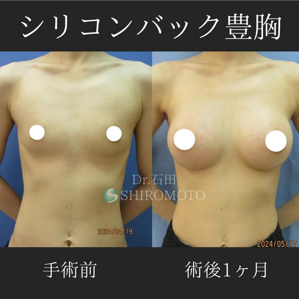 シリコンバック豊胸（術前・術後）①