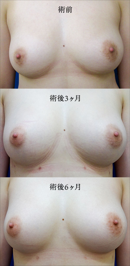 シリコンバック豊胸（術前・術後）②